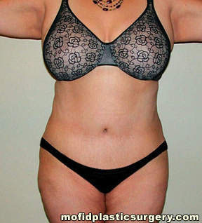 Tummy Tuck Case 2564 After Photo Tummy Tuck