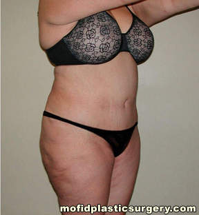 Tummy Tuck Case 2564 After Photo Tummy Tuck