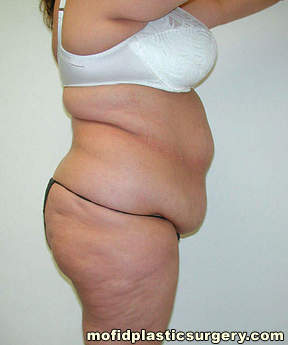 Tummy Tuck Case 2564 Before Photo Tummy Tuck