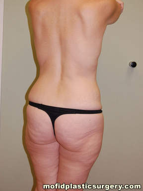 Tummy Tuck Case 2580 Before Photo Tummy Tuck