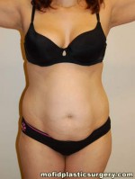 Tummy Tuck