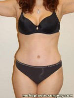 Tummy Tuck