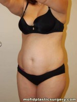 Tummy Tuck