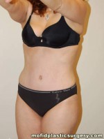 Tummy Tuck