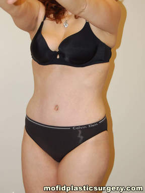 Tummy Tuck Case 2590 After Photo Tummy Tuck