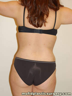 Tummy Tuck Case 2590 After Photo Tummy Tuck