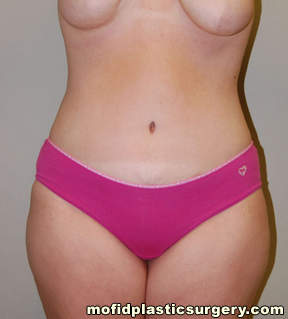 Tummy Tuck Case 2606 After Photo Tummy Tuck