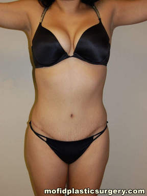 Tummy Tuck Case 2622 After Photo Tummy Tuck