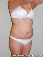 Tummy Tuck