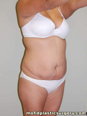 Tummy Tuck Case 2622 Before Photo Tummy Tuck