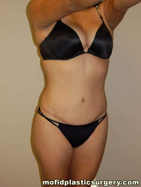 Tummy Tuck Case 2622 After Photo Tummy Tuck