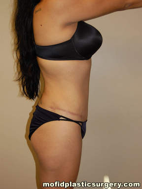 Tummy Tuck Case 2622 After Photo Tummy Tuck