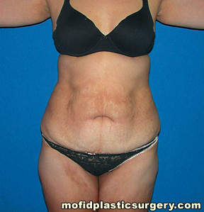Tummy Tuck Case 2630 Before Photo Tummy Tuck