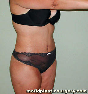 Tummy Tuck Case 2630 After Photo Tummy Tuck