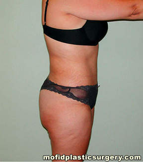Tummy Tuck Case 2630 After Photo Tummy Tuck