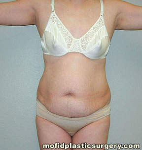 Tummy Tuck Case 2638 Before Photo Tummy Tuck
