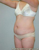 Tummy Tuck