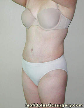Tummy Tuck Case 2638 After Photo Tummy Tuck
