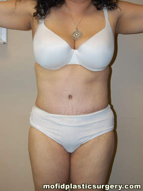 Tummy Tuck Case 2646 After Photo Tummy Tuck