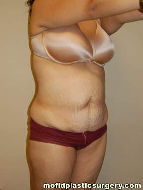 Tummy Tuck Case 2646 Before Photo Tummy Tuck