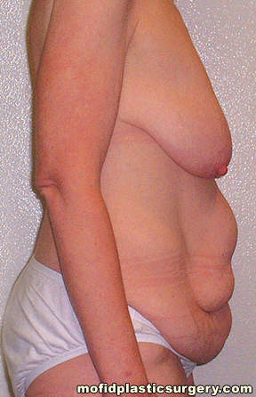 Tummy Tuck Case 2654 Before Photo Tummy Tuck