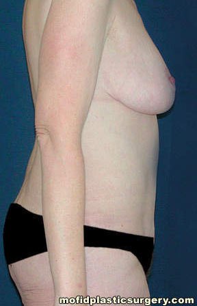 Tummy Tuck Case 2654 After Photo Tummy Tuck