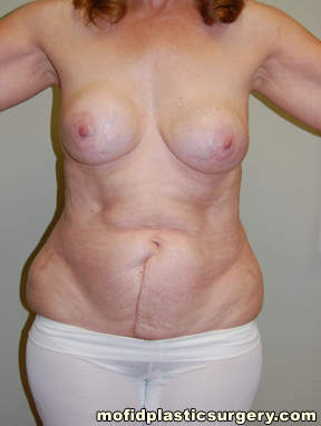 Tummy Tuck Case 2668 Before Photo Tummy Tuck