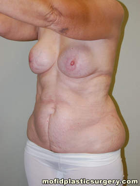 Tummy Tuck Case 2668 Before Photo Tummy Tuck