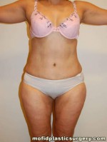 Tummy Tuck