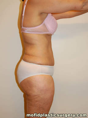 Tummy Tuck