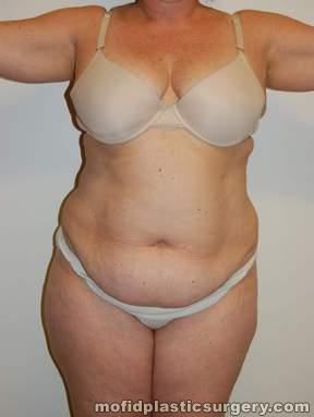 Tummy Tuck