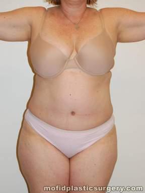 Tummy Tuck