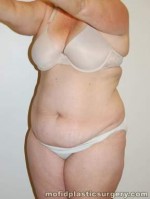 Tummy Tuck