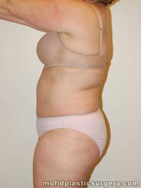 Tummy Tuck