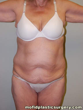 Tummy Tuck