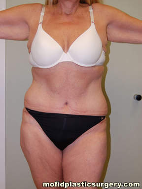 Tummy Tuck