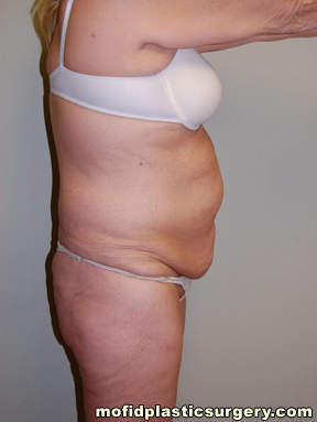 Tummy Tuck