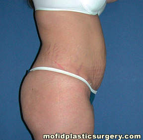 Tummy Tuck