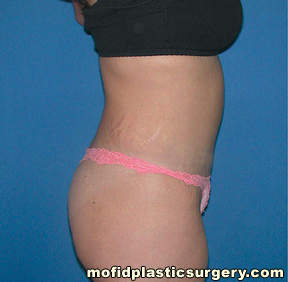 Tummy Tuck