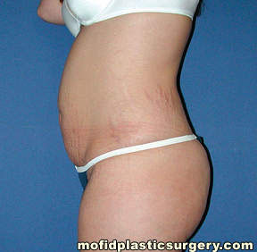 Tummy Tuck