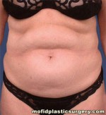 Tummy Tuck