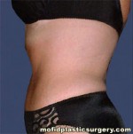 Tummy Tuck