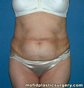 Tummy Tuck Case 2745 Before Photo Tummy Tuck