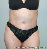 Tummy Tuck