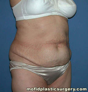 Tummy Tuck Case 2745 Before Photo Tummy Tuck
