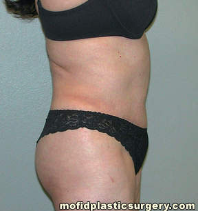 Tummy Tuck Case 2745 After Photo Tummy Tuck