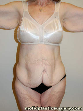 Tummy Tuck Case 2753 Before Photo Tummy Tuck