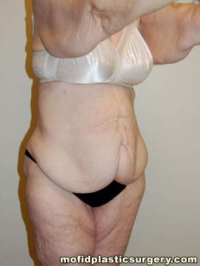 Tummy Tuck Case 2753 Before Photo Tummy Tuck