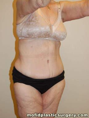 Tummy Tuck Case 2753 After Photo Tummy Tuck