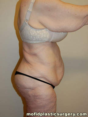 Tummy Tuck Case 2753 Before Photo Tummy Tuck
